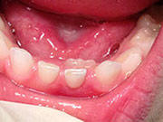 Baby Teeth Behind Adult Teeth